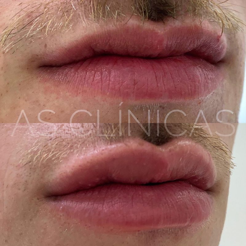 Preenchimento Labial Caso 9 As Clínicas